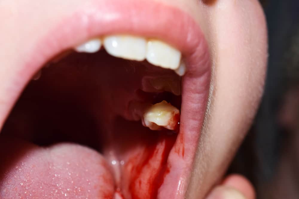 6 Spiritual Meanings When You Dream Teeth Falling Out With Blood